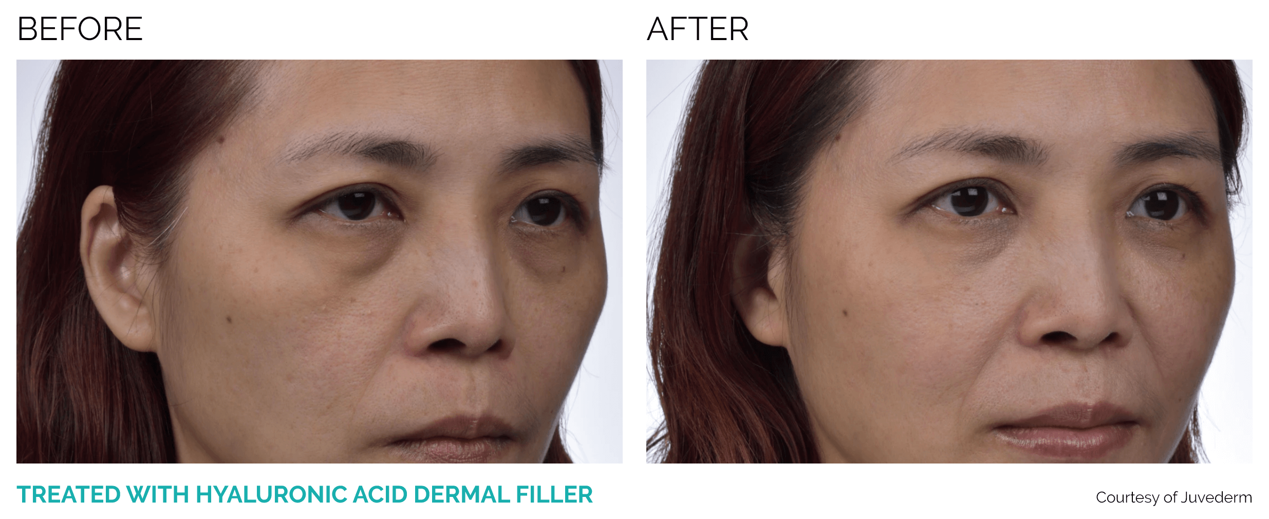juvederm_volite_bf4
