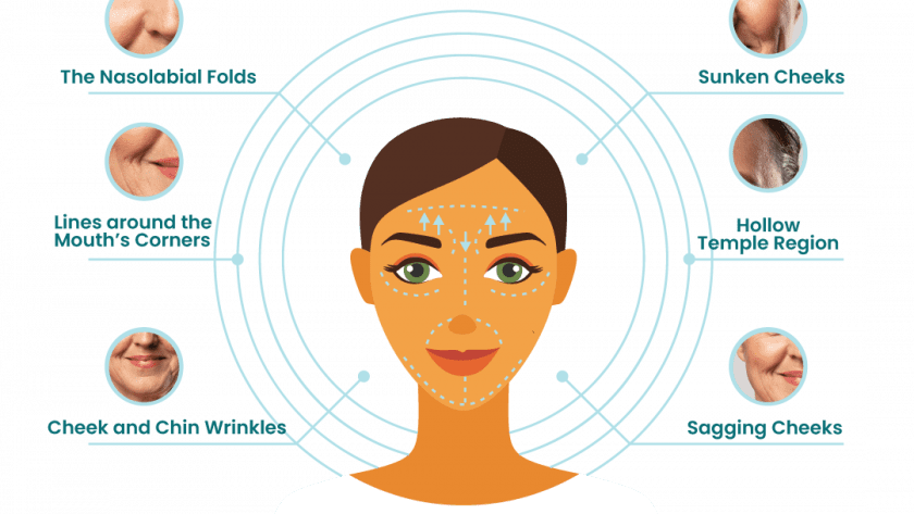 Illustration of treatment areas for Sculptra skin booster, highlighting improvements in nasolabial folds, lines around the mouth’s corners, cheek and chin wrinkles, sunken cheeks, hollow temple region, and sagging cheeks.
