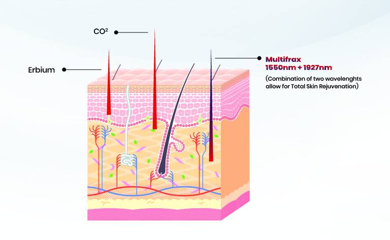 MultiFrax Laser Skin Rejuvenation
